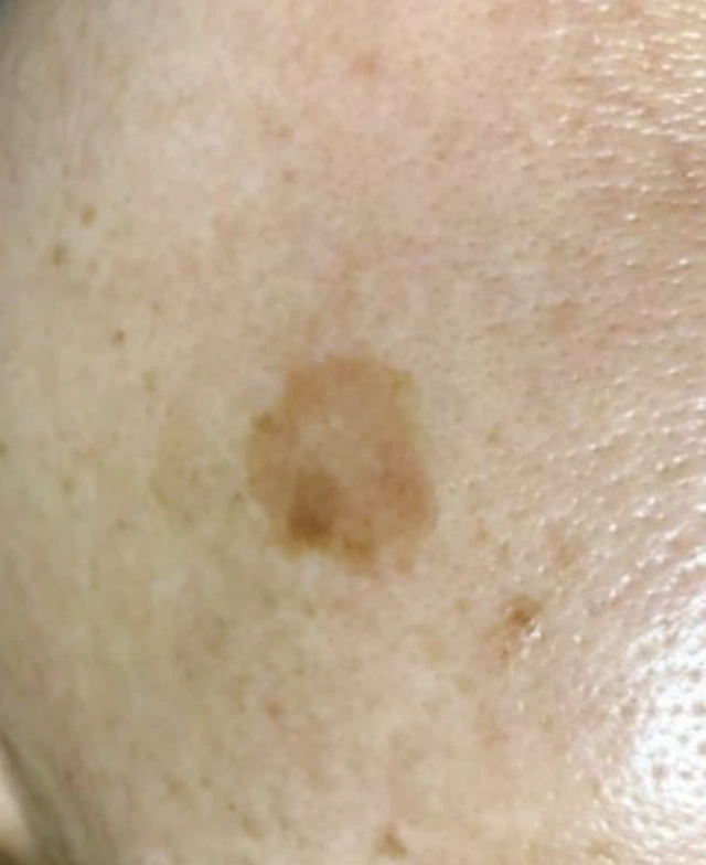 30s-melasma-spots